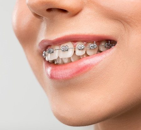 orthodontics dental treatment in houston